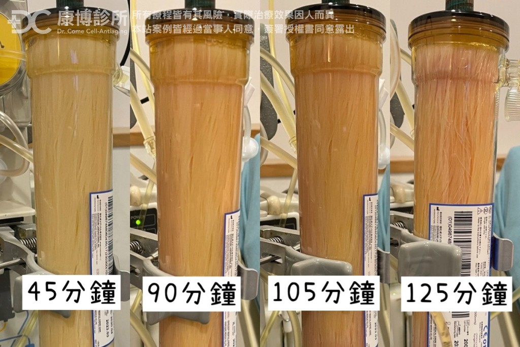 王先生過濾出來的廢液,是鮮少會出現的“橘紅色帶著乳糜塊”,王先生驚訝的表示:「如果沒有做血液淨化,都不知道自己的血液這麼髒!」
