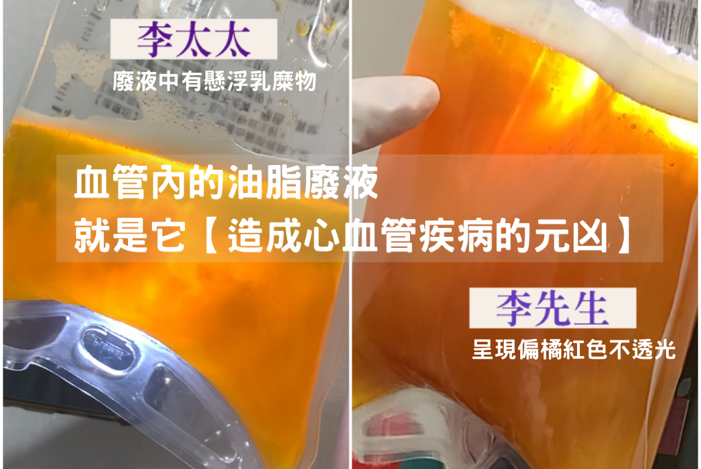 血液淨化過程中,雖然沒有像先生一樣洗出過多血脂而需要濾芯拍打,廢液量也沒有像先生這麼誇張,但最後卻排出許多的發炎物質與懸浮乳糜物,這也大大的讓李太太驚訝!