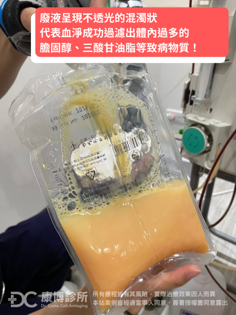醫師拿著呂先生洗出的橘黃色廢液解釋道:「這包滿滿的油脂,代表血液淨化已經成功過濾出您體內過多的膽固醇、三酸甘油脂等致病物質!現在您的各項數值都會有明顯的改善。」