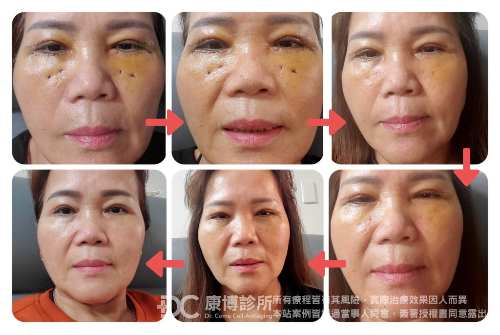 65歲的陳小姐多年來飽受自律神經失調困擾,一直看醫生用藥都無法改善,心情跟著越來越差,變得不想出門接觸人群,甚至有了想不開的念頭。直到朋友介紹她到康博診所進行YPRP保養,身心狀況都明顯提升,護理師親切的陪伴讓她展現更多笑容!最近到醫美診所進行雙眼皮及眼袋手術,有了YPRP輔助,修復速度也快了許多!