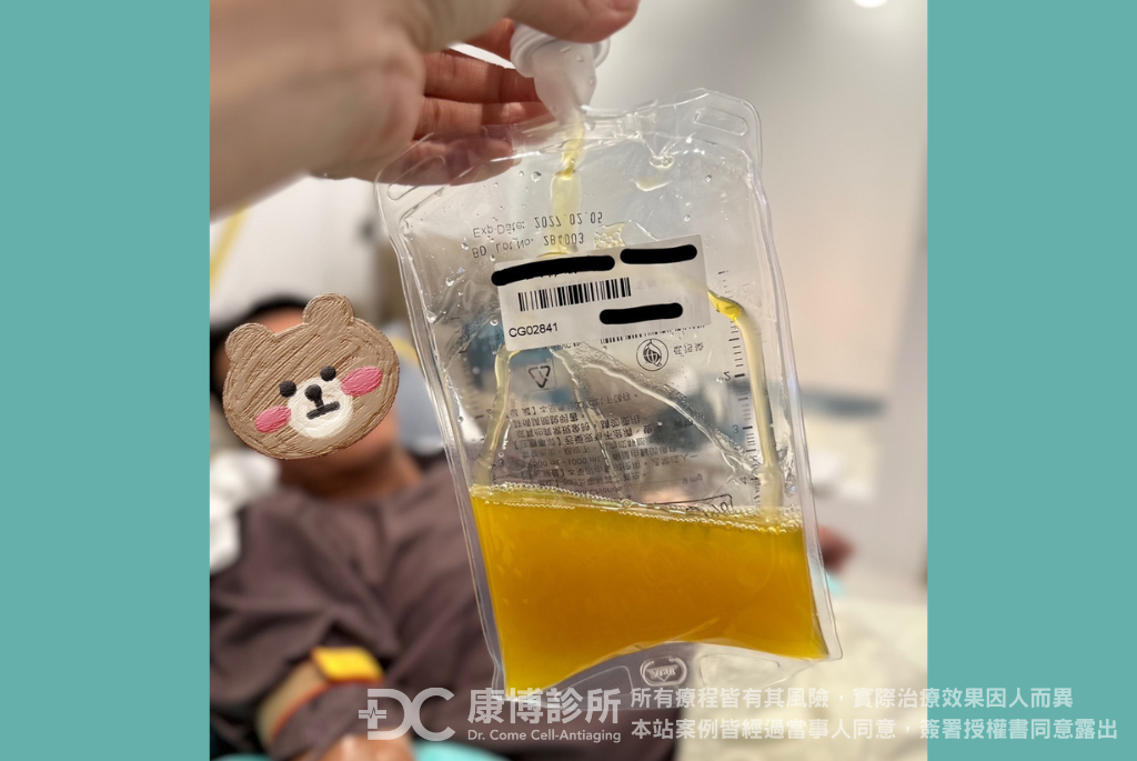 50歲的羅先生血壓偏高,三年前在其他醫美診所做過血液淨化,這次來到康博診所感受到專業服務,從醫師諮詢、護理師衛教,包含施作當天也有泰晶殿的芳療師按摩舒壓。此次的血淨廢液非常濃稠且有沉澱物,為了保持健康,開始調整作息及飲食,讓自己不再處於亞健康狀態。